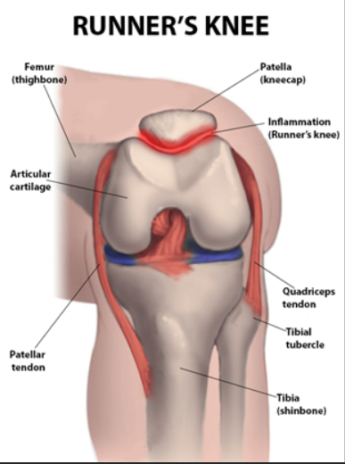 Overcoming Runner's Knee: A Guide to Effective Physical Therapy and Recovery