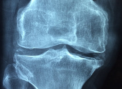 Osteoporosis and Physical Therapy