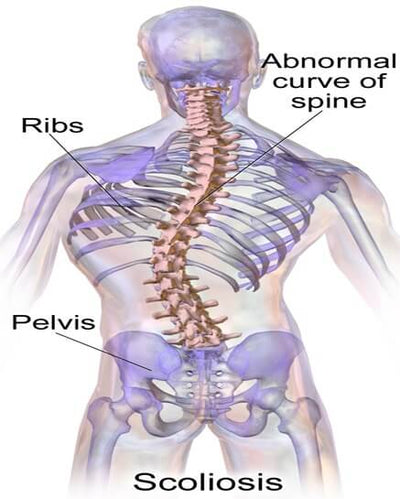How can Chiropractic Help with Scoliosis